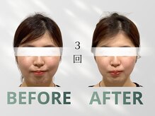 ハリット(haritt)/美容鍼B/A