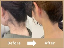 ミース 宮崎店/『うなじ矯正』でうなじ美人に