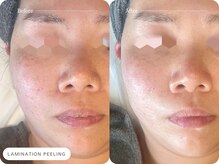 キュレイテッドスキン(CURATED SKIN)/ニキビ/シミ/毛穴/肌質改善/神戸