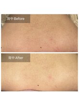 癒える(ielu)/背中★陶肌ハーブピーリング