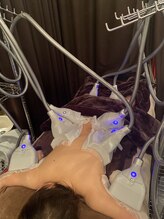 ブルースター(Blue Star)/脂肪冷却8カップ施術風景