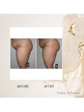 クーラ テュセ(Coeur la Tusais)/太ももの脂肪撃退コース