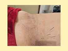 はりきゅう和 ルート鍼灸院/皮ふ