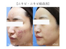 エピア 豊田店(Epia)/大人ニキビケア・赤み跡改善