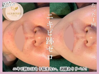 ハーバリー 天王寺(HERBERRY)/ハーブピーリング専門店HERBERRY