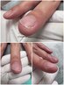 【手の巻き爪1ヵ所】