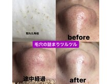 ビューティーネイル(Beauty Nail)/毛穴エクストラクション