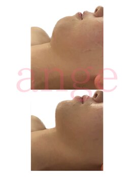 アンジェ(ange)/ange式小顔リフト