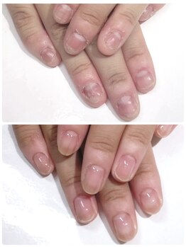 インブロッサム(imblossom)/深爪矯正/自爪育成