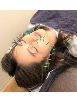 スカイ 鍼灸整骨院 整体院(SKY)/美容鍼