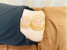 スポーツラボ鍼灸接骨院(スポーツLab鍼灸接骨院)/カッピング