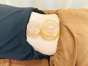 スポーツラボ鍼灸接骨院(スポーツLab鍼灸接骨院)/カッピング