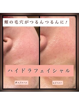 ティアメディカル(Tia Medical)/ハイドラフェイシャル