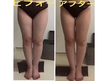 アルページュ(Arpege)/痩身インディバで脚長ライン造り