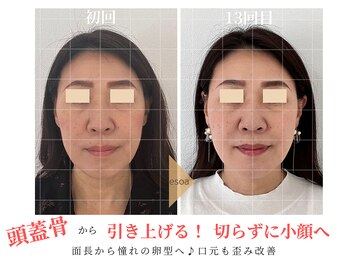 エソア(esoa)/40代 小顔矯正