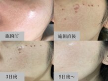 シミケア直後からの経過。施術後メイクok、テープ不要です。
