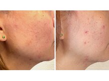 ロッタ エクリュ(Lotta ecru+)/再生因子の力で・・・