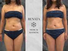 レナータ 六本木(RENATA)/【脂肪冷却】経過写真