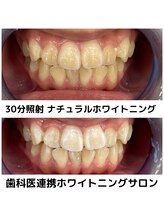 プラチナムビューティ 四条烏丸店(PLATINUM Beauty)/ホワイトニングビフォーアフター