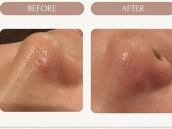 美々庵/ハイドラ 毛穴洗浄