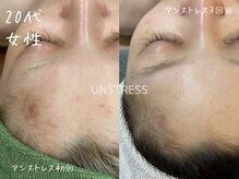 ミコサロン(miko salon)/乳酸菌ピーリング