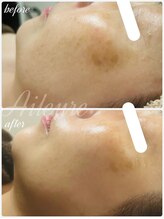 エルール トータルビューティ(Aileure total beauty)/ララピール　肌質改善