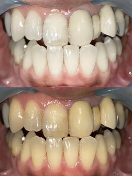 アルクローゼット(aru closet)/ホワイトニングビフォーアフター