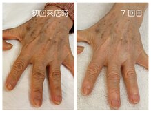 キレイテ 福岡天神店/60代/7回目【福岡ハンドケア】