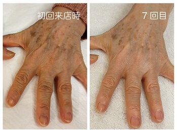 キレイテ 福岡天神店/60代/7回目【福岡ハンドケア】