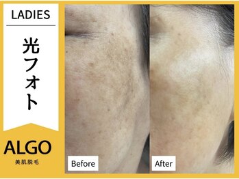 アルゴ 敦賀店(ALGO)/３０代女性８回目　光フォト