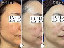 ラヴレボーテ(La Vraie Beaute)/50代・シミしわ・改善期間26ヶ月