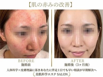 小顔コルギサロン シー(She)の写真/繰り返すニキビ悩みを改善！その場しのぎのケアではなく肌の専門家が根本から改善へ導く◎
