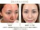 小顔コルギサロン シー(She)の写真/繰り返すニキビ悩みを改善！その場しのぎのケアではなく肌の専門家が根本から改善へ導く◎