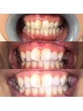 ティースクリーン(Teeth Clean)/セルフホワイトニング3回