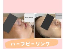 ダイダイ(daidai)/ハーブピーリング