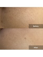 モカ 天王寺店(MOKA)/剥離1回　お尻ニキビケア　毛穴