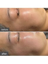 ロッタ エクリュ(Lotta ecru+)/REVI剥けないハーブピーリング