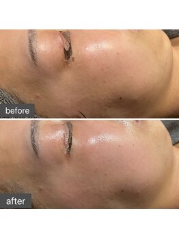 ロッタ エクリュ(Lotta ecru+)/REVI剥けないハーブピーリング