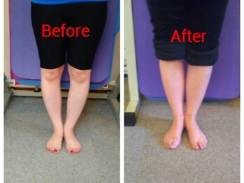 ティーラボ(T-LABO)/３０代女性O脚改善で痛みも改善