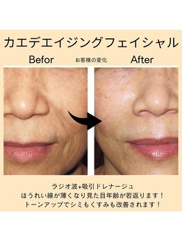 ベルミ―ランド いなげや大和相模大塚/カエデエイジングフェイシャル２