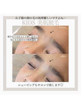 ルーナ(Runa)/キッズ脱毛【子供脱毛】