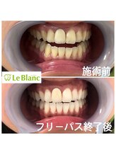 ルブラン 奈良店(Le Blanc)/本来の歯のお色取り戻しました