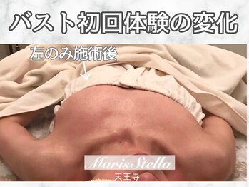 マリスステラ 天王寺(MarisStella)/バスト体験初回の変化