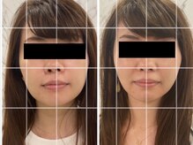 ビノスビューティー(vinos.beauty)/症例　小顔矯正　小顔/毛穴