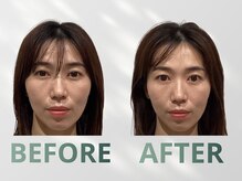 ハリット(haritt)/美容鍼B/A