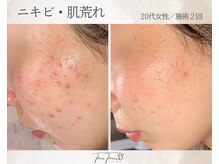 スリースリー(THREE THREE)/ニキビ・肌荒れケア