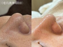 スー 千種 今池(Suu.)/韓国式毛穴洗浄"アクアピール"