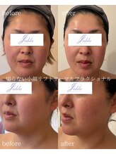 ユフラ(Juhla)/切らない小顔リフトサーマル