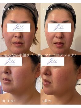ユフラ(Juhla)/切らない小顔リフトサーマル