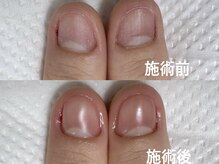 アメジスト(Amethyst)/深爪矯正、初回の様子